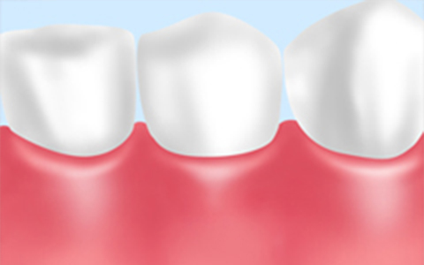 歯周病の予防処置として