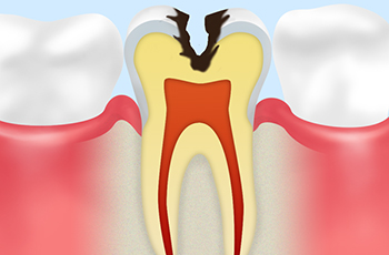 象牙質の虫歯（C2）