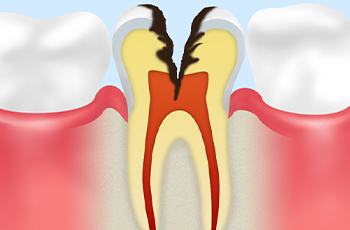 神経にまで達した虫歯（C3）