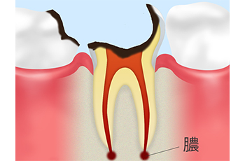 歯根まで達した虫歯（C4）