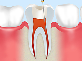  歯の神経の除去